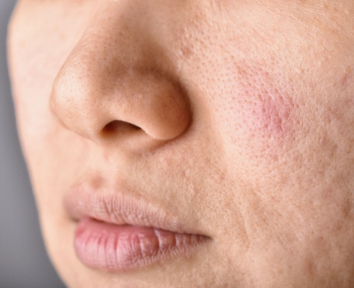 Acne Treatment